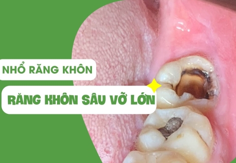 Nhổ răng khôn bị sâu giá bao nhiêu